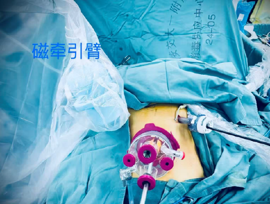 单孔腹腔镜三脏器手术模式示意图