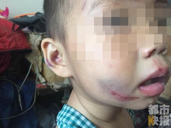 两岁半女孩被母亲打得遍体鳞伤，父亲街头痛哭求助。