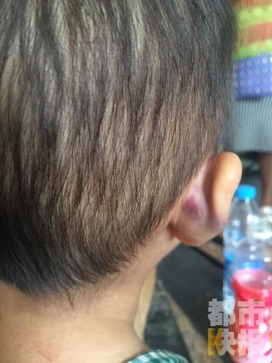 兩歲半女孩被母親打得遍體鱗傷，父親街頭痛哭求助。