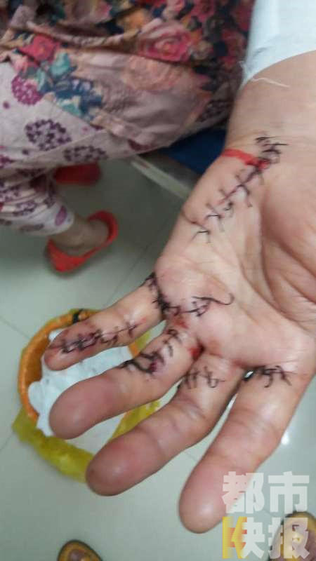 家庭瑣事引爆積怨 媳婦持刀砍傷婆婆