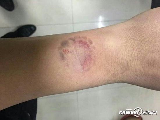被咬傷的地方已經發(fā)青發(fā)黑。
