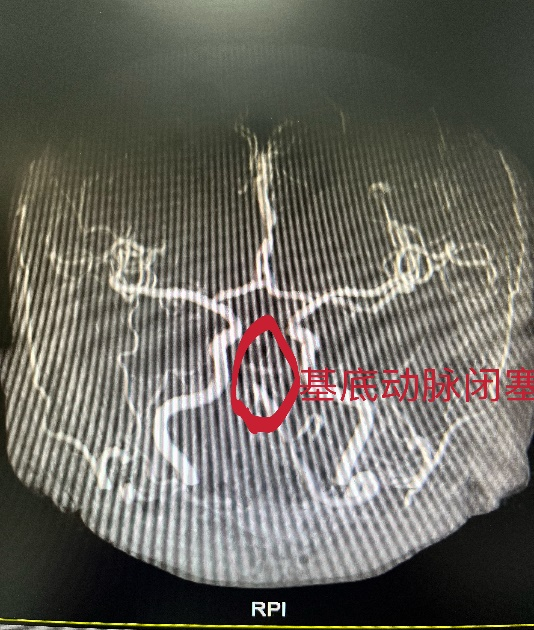 术前基底动脉闭塞