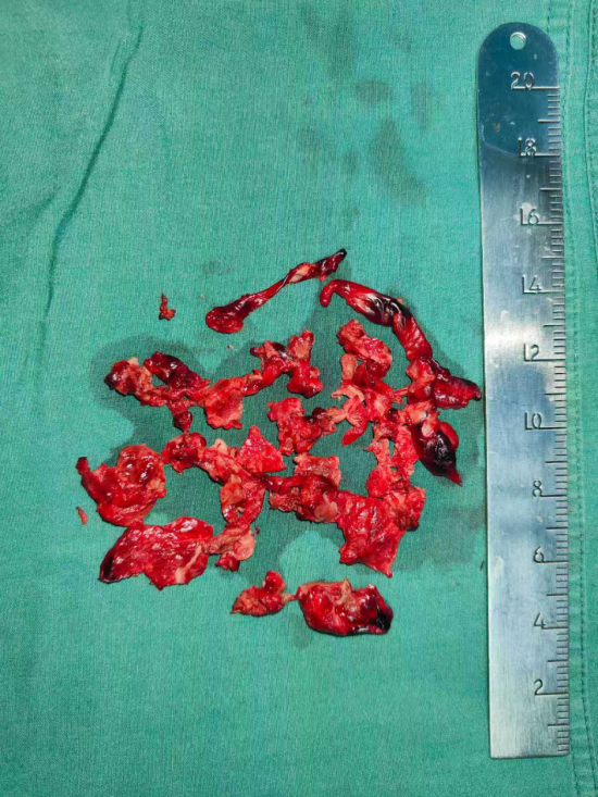 术中取自肺动脉及右心房血栓