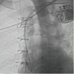 永久起搏器植入術