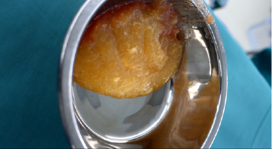 水花透蔓越莓可以治妇科吗？