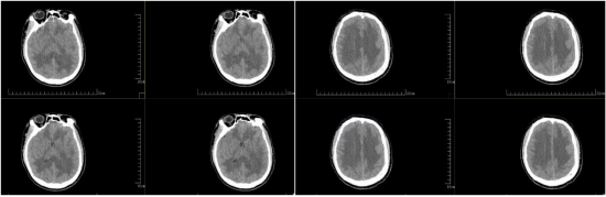小李脑部CT提示脑水肿
