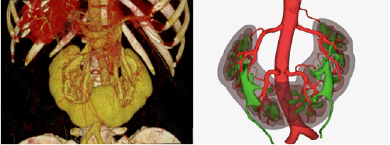 供者马蹄肾CT血管成像（CTA）及三维重建结构图