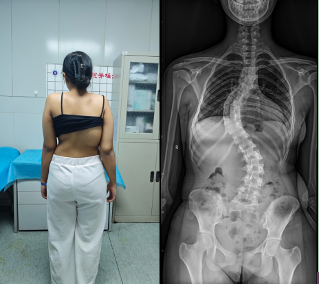 患者侧弯严重，背部畸形明显
