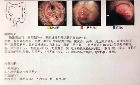 王先生肠镜结果