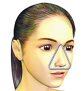 苏州一小伙挤痘痘竟引发败血症 危险三角区是挤痘禁区