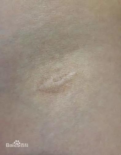 接种卡介苗(BCG)后所引发的“疤痕”局部不良反应(来源:百度百科)