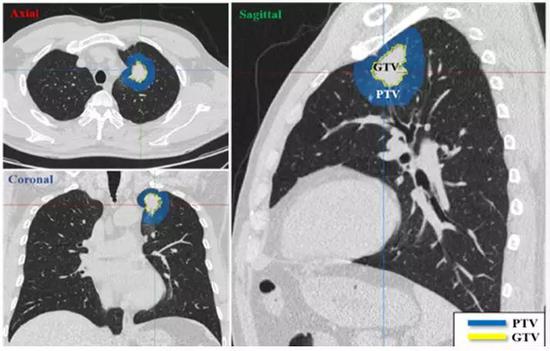 图1 早期肺癌患者CT影像的肿瘤（GTV）以及肿瘤周围环境（PTV）：左上为横断位，左下为冠状位，右图为矢状位