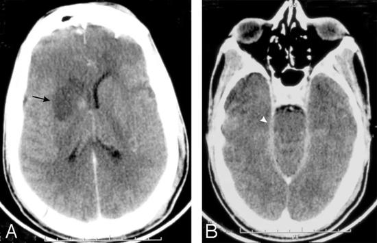 对比度增强的CT脑扫描显示右基底神经节梗塞（箭头，A）和增强的渗出物在脑内池（箭头，B）