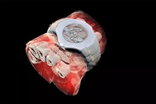 图为MARS扫描仪拍摄的带手表手腕部分的3D彩色X射线图像，白色的是软组织中的部分手指骨，连手表的结构都能完整重现（图片来自网络）