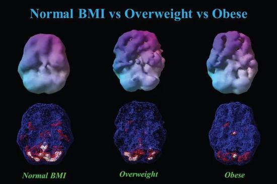 同样40岁，体重正常（BMI = 23）、超重（BMI = 29）和肥胖（BMI = 37）男性平均脑血流3-D灌注图。可见BMI增加，脑血流逐渐减少。
