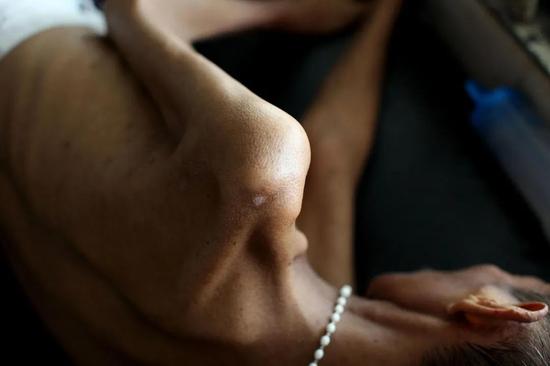 瘦弱的AIDS患者 | Department of Foreign Affairs and Trade / CC BY （https：//creativecommons.org/licenses/by/2.0）