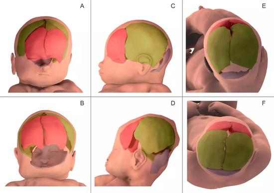 ▲3D MRI画面显示，相较于分娩前（A/C/E），胎儿颅骨各部分在第二产程中（B/D/F）出现了不同程度的重叠（图片来源：参考资料[1]）