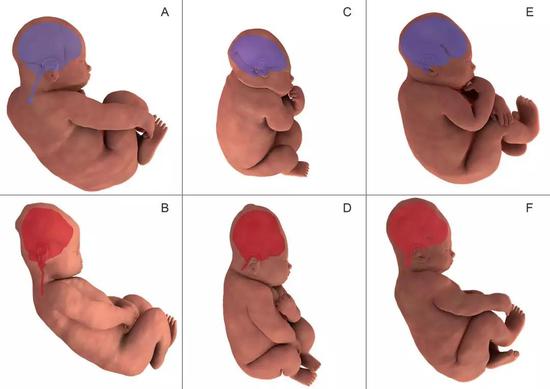  ▲3D MRI画面显示，胎儿大脑的形状在分娩前（A/C/E中的紫色）和第二产程中（B/D/F中的橙色）发生了显著变化（图片来源：参考资料[1]）