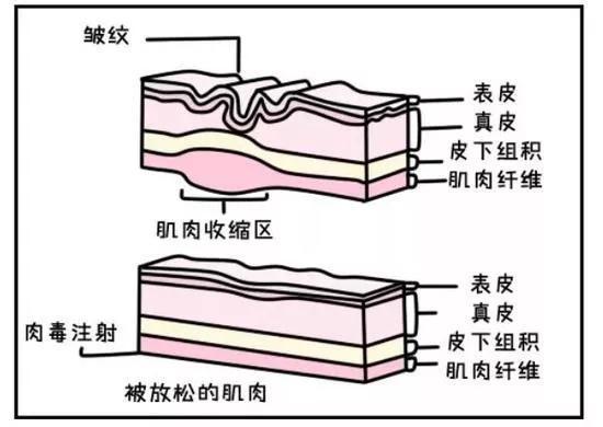 肉毒素除皱的机制(图片来源:360个人图书馆)