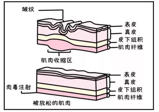  肉毒素除皱的机制（图片来源：360个人图书馆）