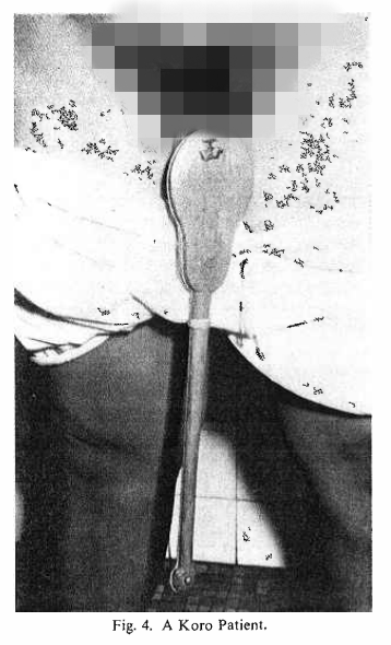 一个害怕Koro病而用夹子将自己生殖器夹住的男性。图片来源： Koro Study Team。 （1969）。 The koro 