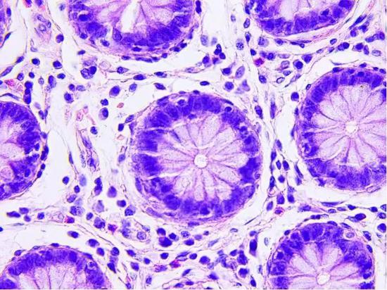 图：显微镜下的结肠癌切片（图片来源：视觉中国）