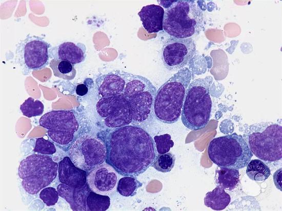 ▲ 弥漫性大B细胞淋巴瘤(图源:imagebank.hematology.org)