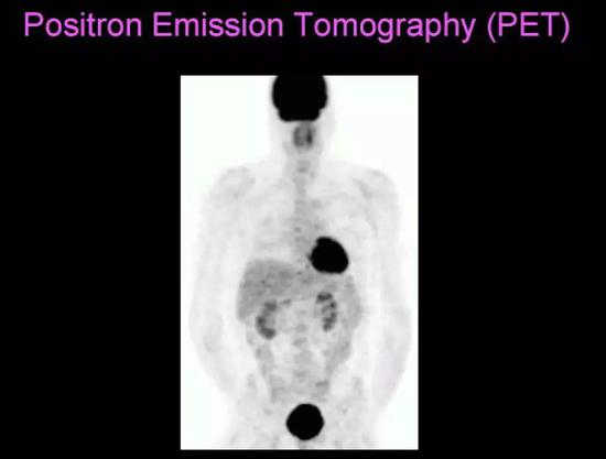  PET下能耗高的大脑和心脏是黑色的