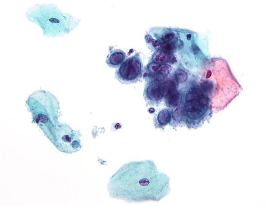  HSV-1感染的细胞（图源：wiki）