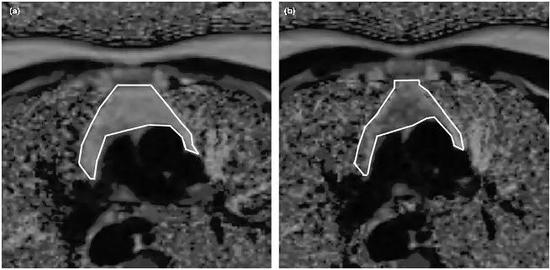 试验志愿者试验前和九个月后胸腺核磁共振图像（图片来源：https：//doi.org/10.1111/acel.13028）
