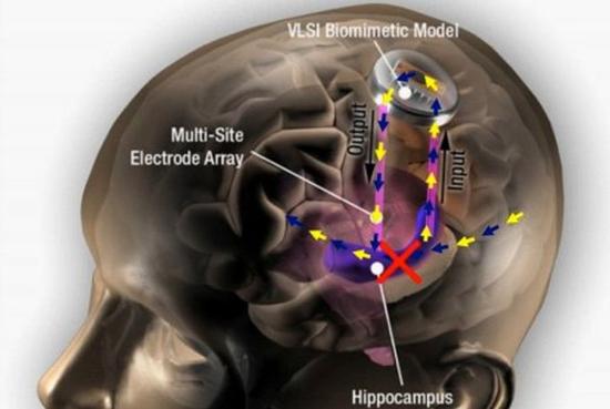 老年痴呆终结？未来大脑将植入记忆芯片 