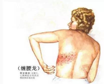 蛇缠腰图片:流言揭秘:“缠腰火龙”、“缠腰蛇”长满一圈就死人? 图片来源网络