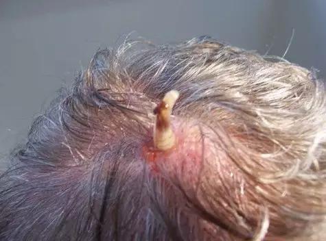 螺旋锥蝇:五种噬肉生物都是怎么整死人的? 人皮蝇幼虫,图源:Reddit