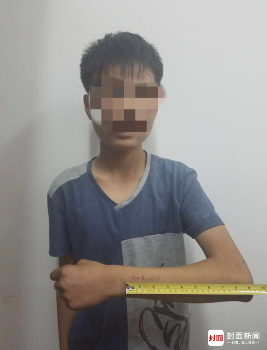 手臂上刻蓝鲸图片 相关“蓝鲸游戏”受害少年之一。