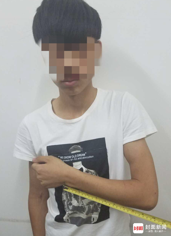 手臂上刻蓝鲸图片 相关“蓝鲸游戏”受害少年之一。