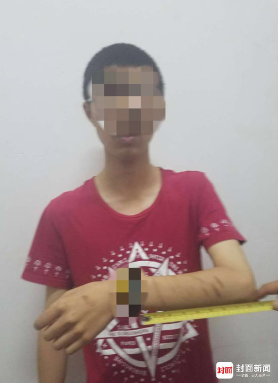 手臂上刻蓝鲸图片 相关“蓝鲸游戏”受害少年之一。