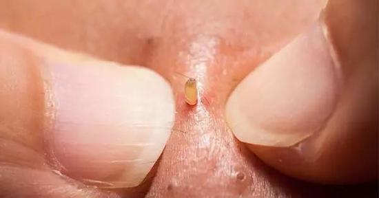 挤痘痘视频:为何我们喜欢看挤痘痘视频?可搜索"PimplePopping" 图源:Yibada