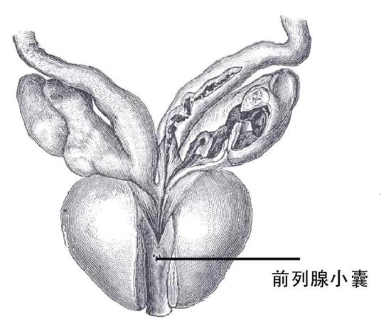 苗勒管永存综合征