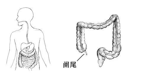 苗勒管永存综合征