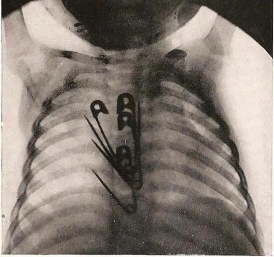 X光片显示编号1071的孩子吞下了4个超大号别针