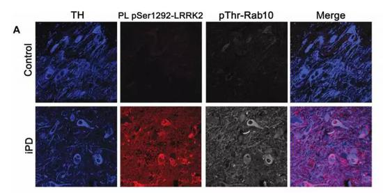 ▲在特发性帕金森病患者中（下图），LRRK2得到了激活（图片来源：《Science Translational Medicine》）