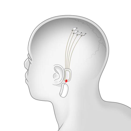 Neuralink的第一个脑机接口效果图