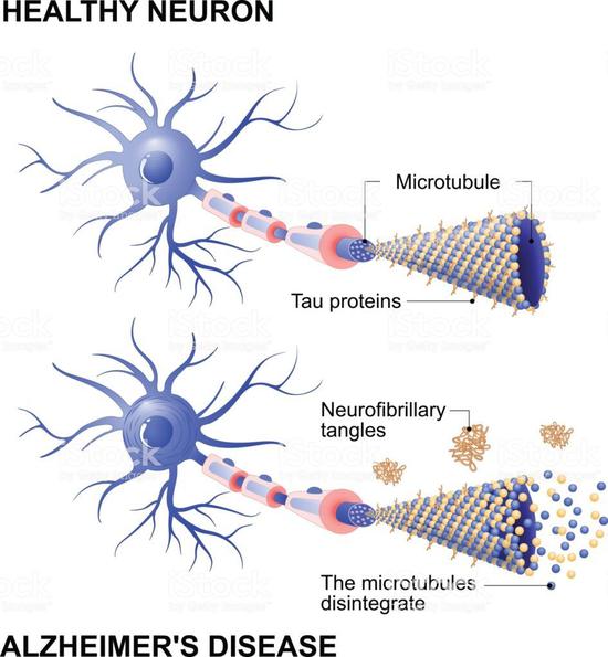 神经元和tau蛋白致病原理