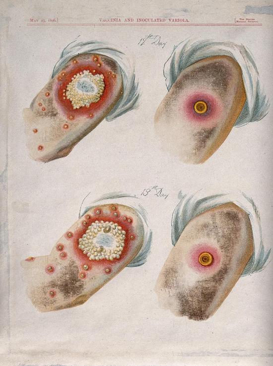接种12-13天后，人痘接种（左）和牛痘接种（右）后的比较。图片来源：Wellcome Library， London
