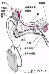 人工耳蜗示意图