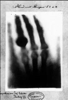世界上第一张X光片——伦琴妻子的手 图片来自：Wikimedia Commons