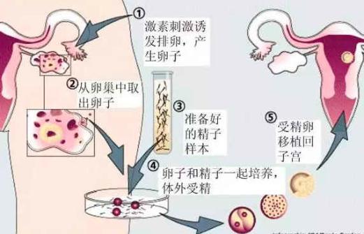 试管婴儿流程图（图片来源于网络）