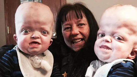 患有一种叫斐弗综合征罕见遗传病的双胞胎与她们的曾祖母