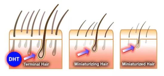 患有”早秃“的男性则携带了对雄激素异常敏感的基因。