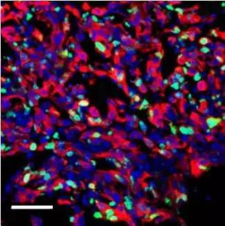 诱导炎症后肿瘤细胞快速生长  图中红色的是肿瘤细胞，绿色是和增殖有关的蛋白Ki67，紫色是DNA